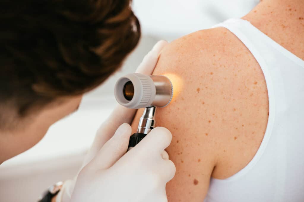 Skin Cancer
