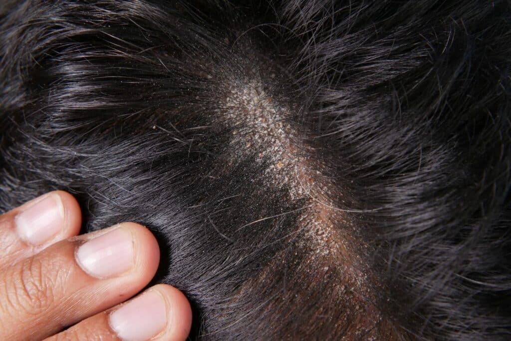 dandruff