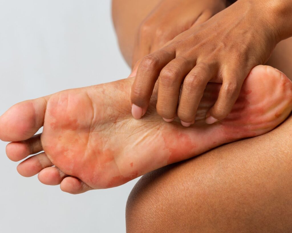 fungal infection