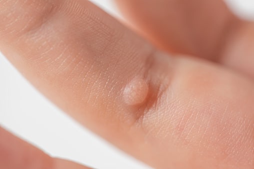 Warts