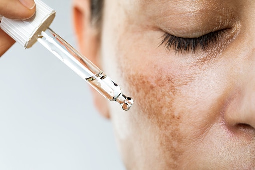 Pigmentation & Melasma
