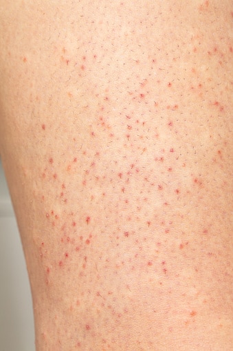 Folliculitis