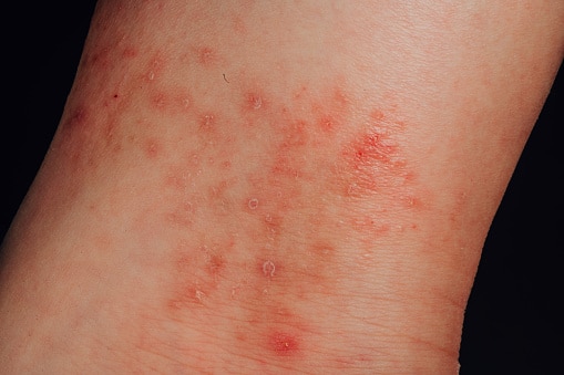 Eczema