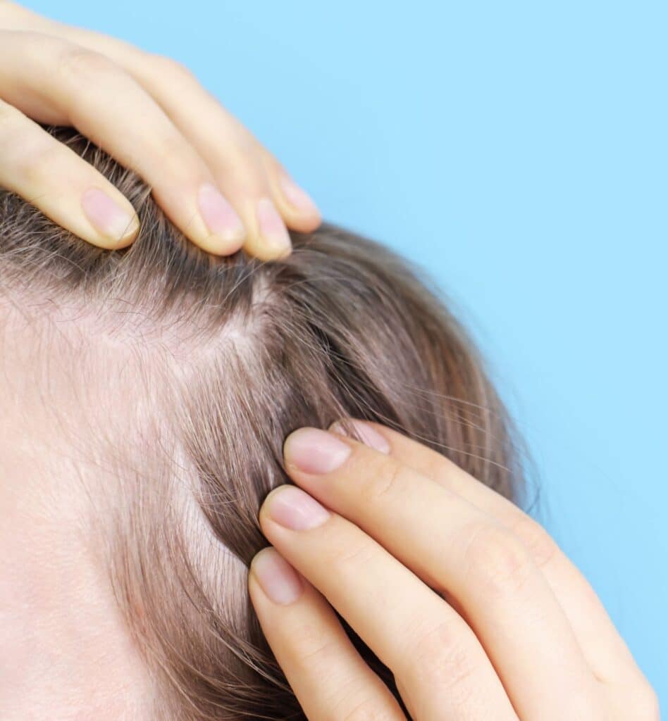 hair loss