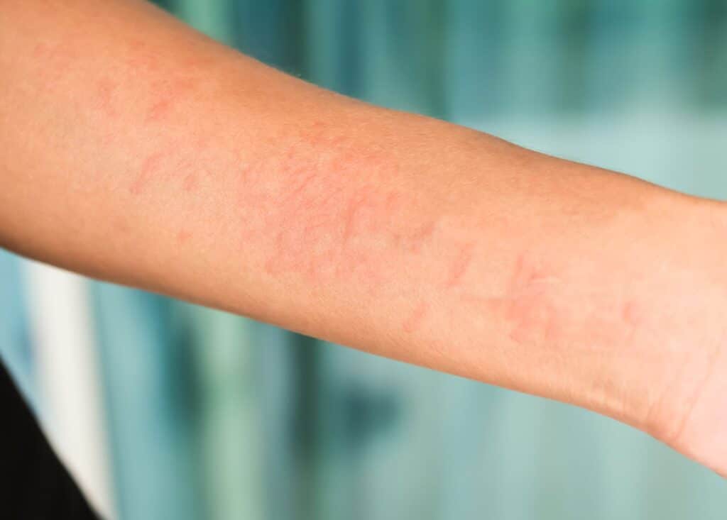 hives