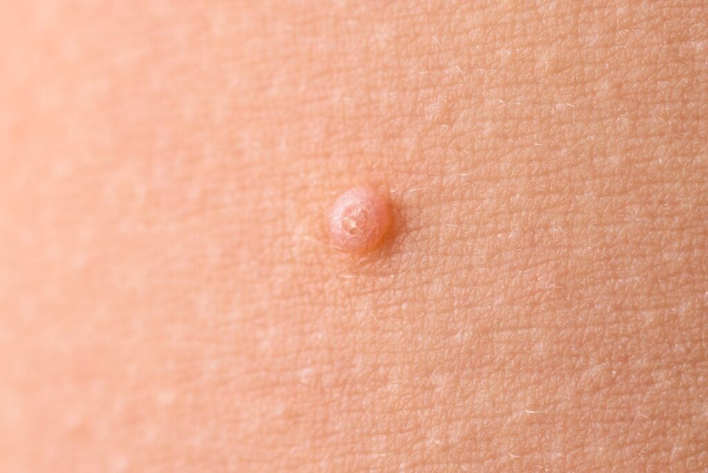 molluscum