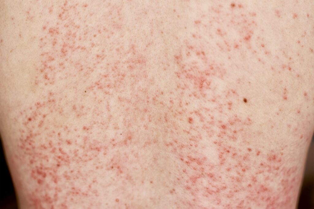 rash