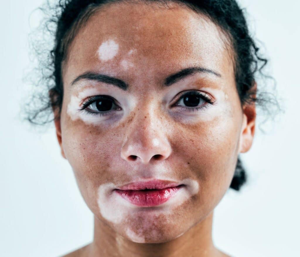 vitiligo