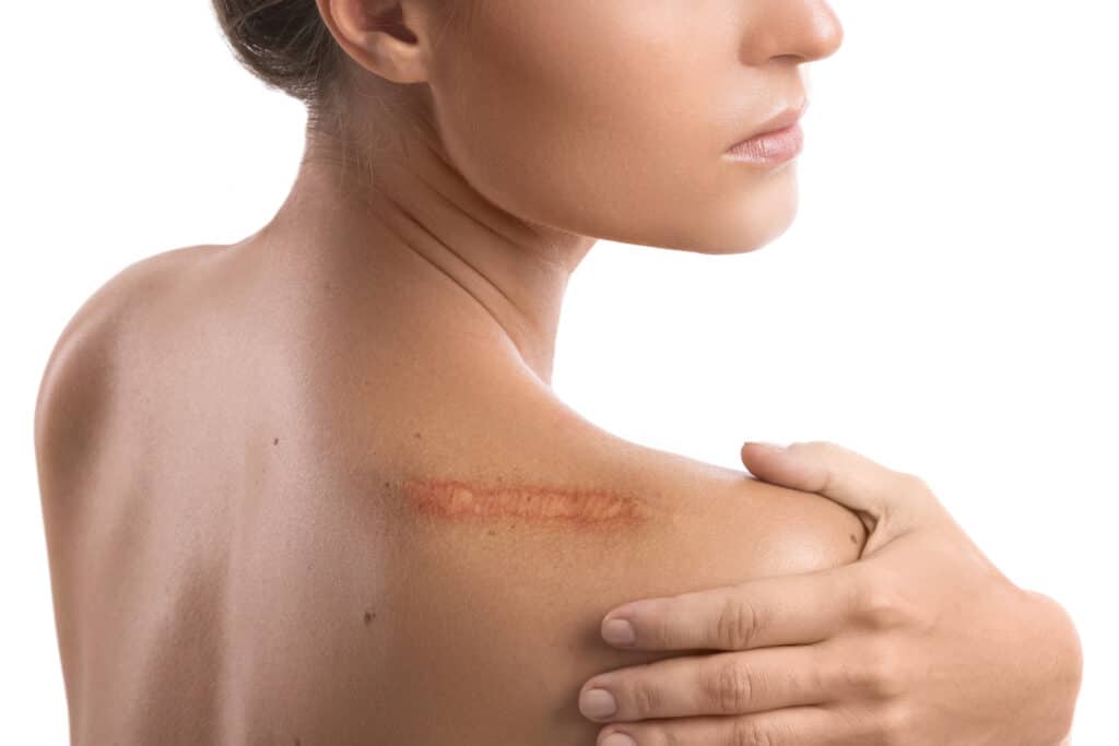 Woman with a scar on her shoulder